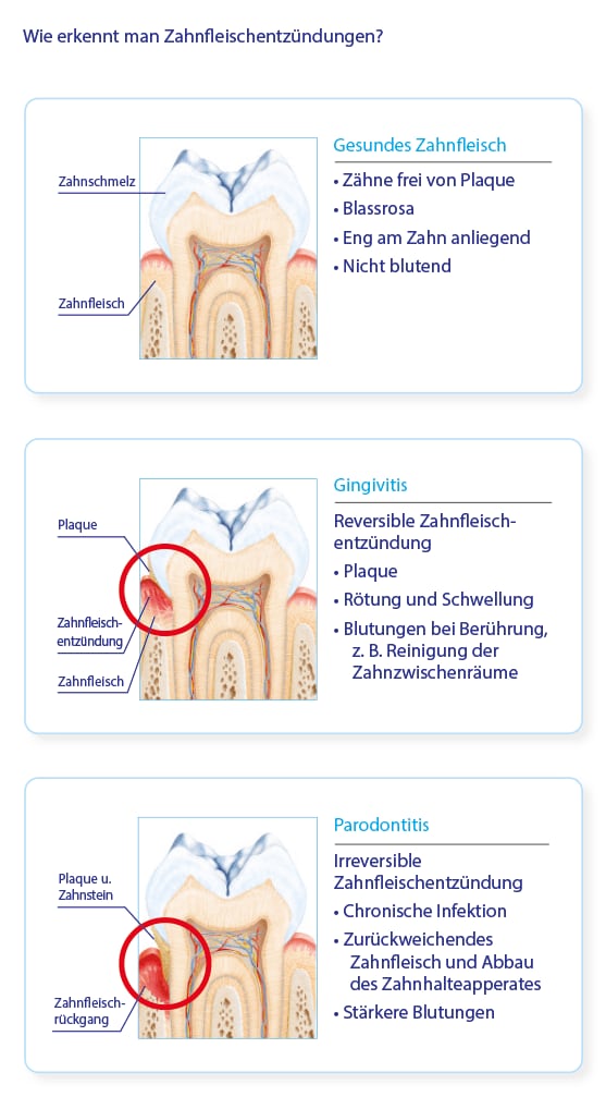 Gingivitis & Parodontitis
